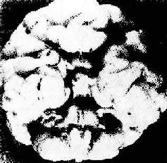 ���壨Patau���ۺ����Ի���