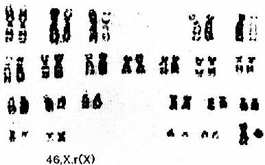 Turner�ۺ�����һ�ֺ��� 46,X,r(X)